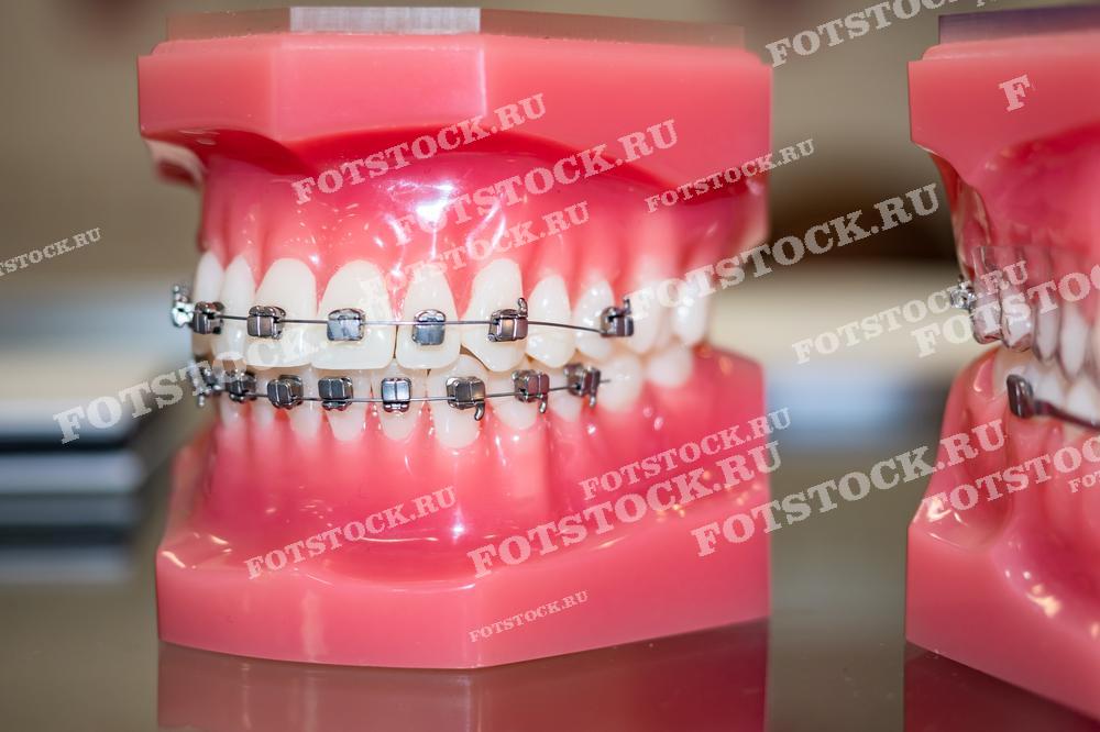 На фотографии изображена стоматологическая модель с металлическими брекетами, предназначенная для демонстрации ортодонтического лечения. Брекеты используются для исправления прикуса и выравнивания зубов. Модель помогает визуализировать процесс установки и функционирования ортодонтической системы.